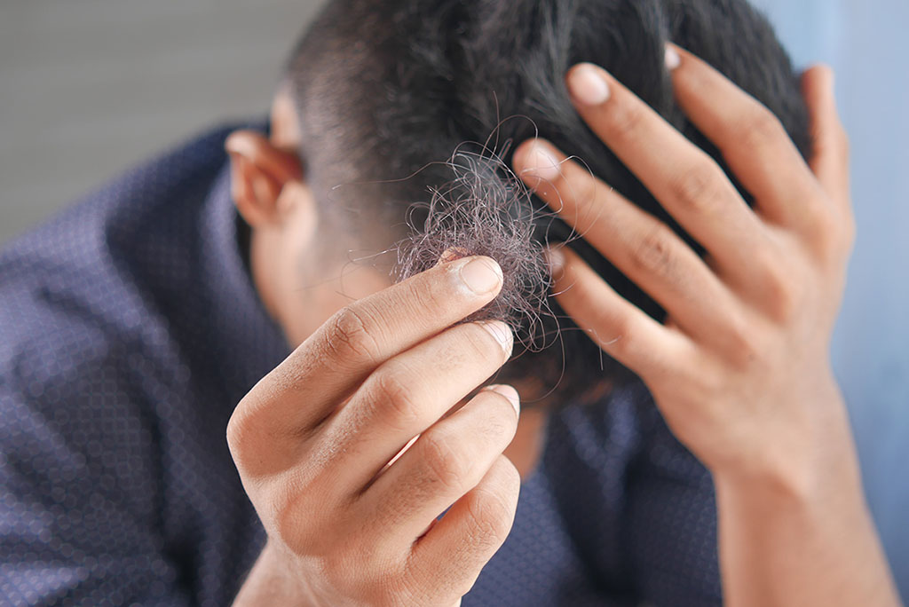 hair loss induced by stress